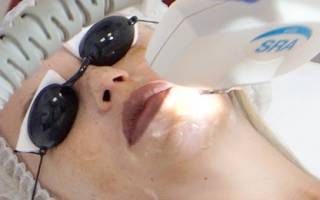 Можно ли удалять пигментные пятна лазером летом