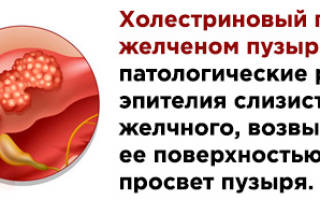 Холестериновый полип желчного пузыря можно ли вылечить
