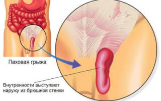 Можно ли вылечить паховую грыжу