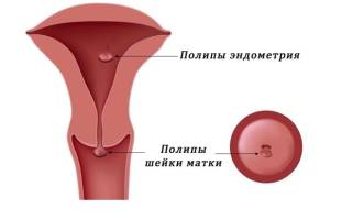 Можно ли не удалять полип в матке