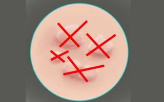 Можно ли удалять папилломы