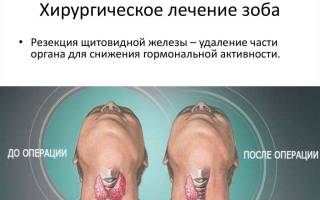 Можно ли вылечить зоб
