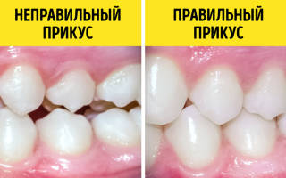 Можно ли поставить брекеты на несколько зубов