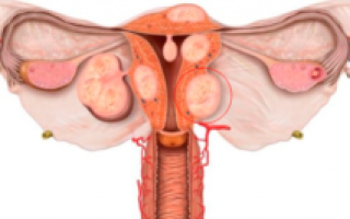 Можно ли удалить миому при гистероскопии