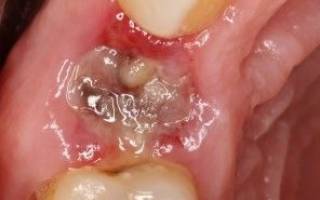 Можно ли удалить сразу 2 зуба мудрости