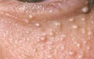 Можно ли удалять жировики на лице