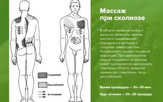 Можно ли делать массаж при сколиозе