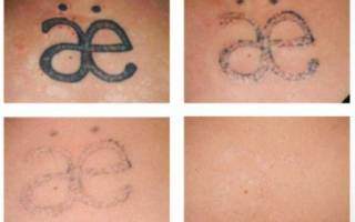 Можно ли удалить татуировку