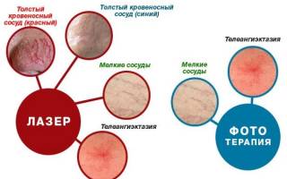 Можно ли удалять сосуды на лице летом