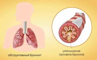Можно ли делать ингаляции при бронхите