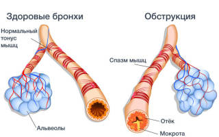 Можно ли вылечить хронический бронхит