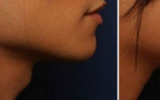 Можно ли удалить кадык