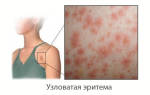 Можно ли принимать дону при узловатой эритеме