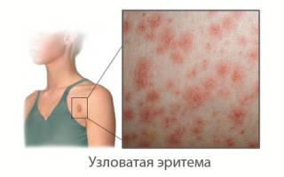 Можно ли принимать дону при узловатой эритеме