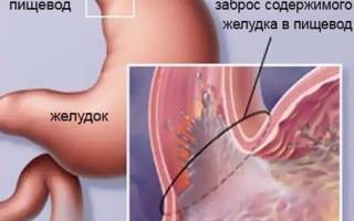 Можно ли пить при изжоге