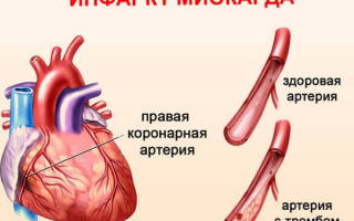 Можно ли пить милдронат