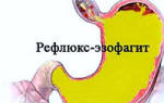 Можно ли вылечить эзофагит