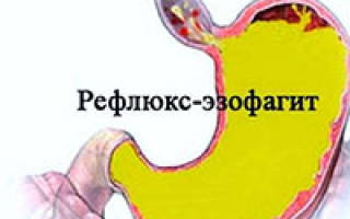 Можно ли вылечить эзофагит