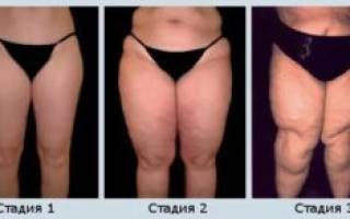 Можно ли вылечить слоновость ног