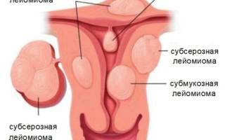 Можно ли вылечить миому матки без операции