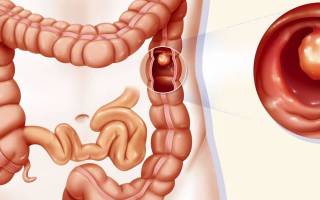 Фиброэпителиальный полип можно ли удалить чистотелом