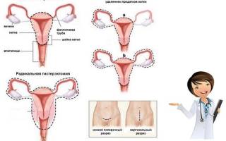 Можно ли забеременеть если удалена матка