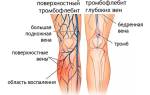 Можно ли вылечить тромбофлебит