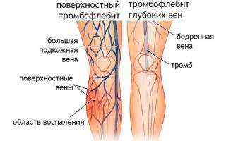 Можно ли вылечить тромбофлебит