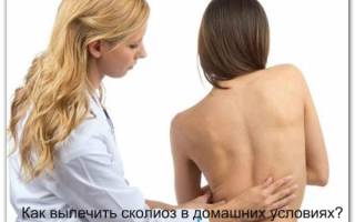 Можно ли вылечить сколиоз 1 степени