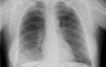Можно ли поставить диагноз левосторонняя среднедолевая пневмония