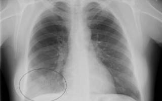 Можно ли поставить диагноз левосторонняя среднедолевая пневмония
