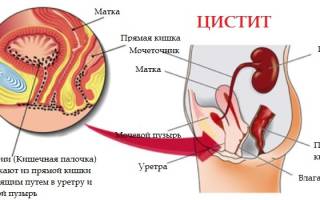 Можно ли пить при цистите