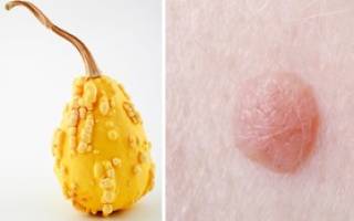 Можно ли удалять бородавки