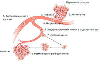 Можно ли вылечить метастазы в легких