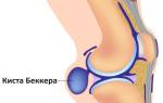 Можно ли вылечить кисту бейкера без операции