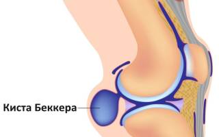 Можно ли вылечить кисту бейкера без операции