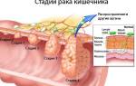 Можно ли вылечить рак прямой кишки