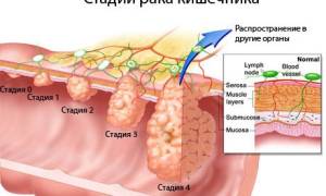 Можно ли вылечить рак прямой кишки