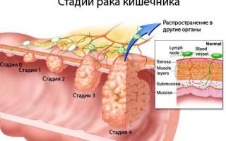 Можно ли вылечить рак прямой кишки