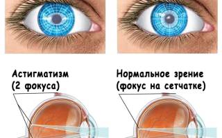 Можно ли вылечить астигматизм