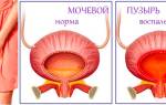 Можно ли вылечить хронический цистит