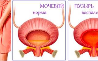 Можно ли вылечить хронический цистит