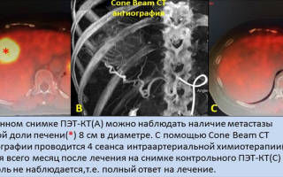 Можно ли вылечить метастазы в печени