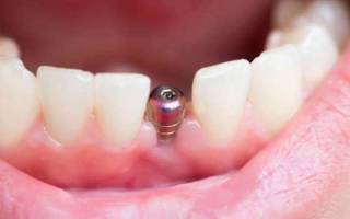 Можно ли устанавливать импланты при пародонтозе
